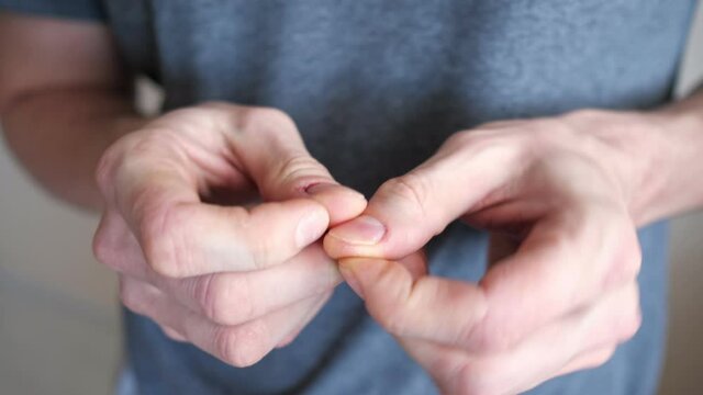 Man in grey t-shirt scratches agnail on finger suffering from neurosis on blurred beige background in light room extreme close crop view
