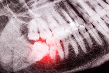 An unerupted semi-retired wisdom tooth on an x-ray picture, macro. Pericoronaritis, surgical dentistry