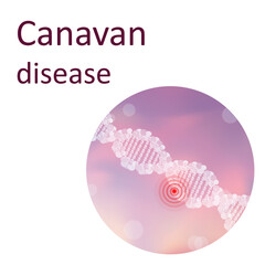 Canavan disease. Genetic. DNA double helix. Medical illustration.