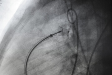 x ray image perform PDA device closure after treatment patent ductus arteriosus disease (PDA),...
