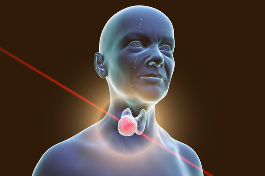 Thyroid cancer in women, illustration showing tumor inside thyroid gland