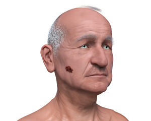 Melanoma on face skin, computer illustration