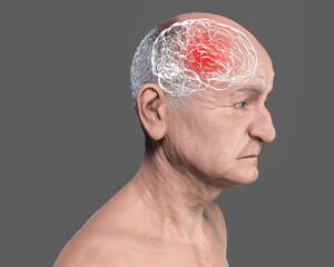 Dementia, conceptual illustration showing an elderly person with progressive impairments of brain functions