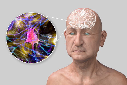 Dementia, conceptual illustration, computer illustration
