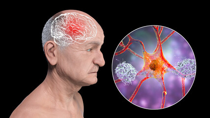 Dementia, conceptual illustration showing an elderly person with progressive impairments of brain functions
