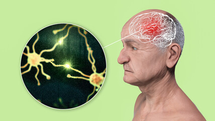 Dementia, conceptual illustration showing an elderly person with progressive impairments of brain functions, distruction of neurons and their networks - obrazy, fototapety, plakaty