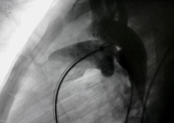 Aortography showed patent ductus arteriosus (PDA) during PDA closure device via endovascular procedure.