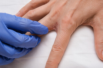 A doctor dermatologist examines patients hand with interdigital dermatitis, dyshidrotic eczema on hand