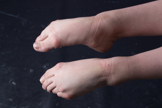 Ballerina feet with some marks on the skin