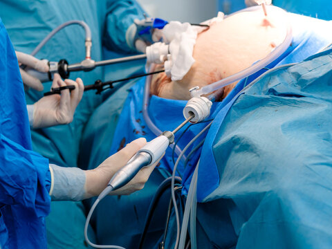 A surgeon in latex gloves and a blue uniform holds special medical instruments during a laparoscopic minimally invasive operation. Treatment of proctological diseases.
