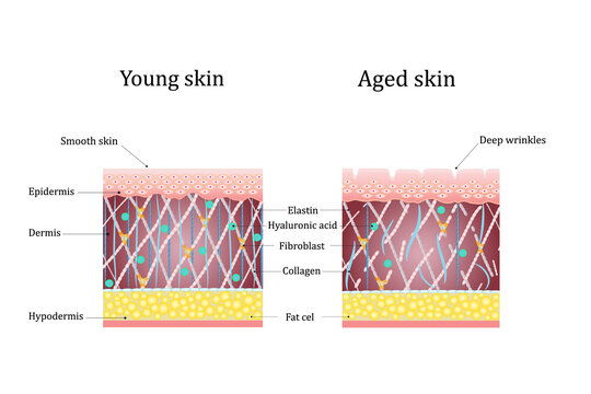 Vector illustration of age-related changes in the skin. Comparison of young and old skin. Structure human skin with collagen and elastin fibers, fibroblasts.