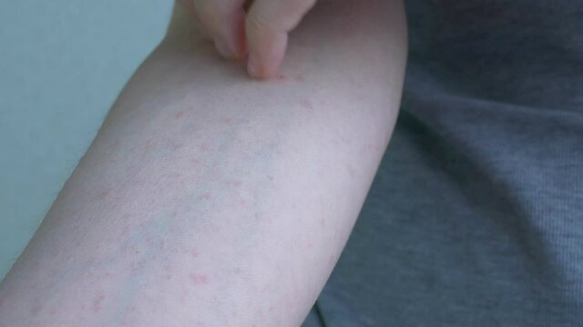 In the interval from the elbow to the hand, close-up shows small light pink inflammation of the skin. Itchy skin is scratched with nails. Viral diseases. Close-up.