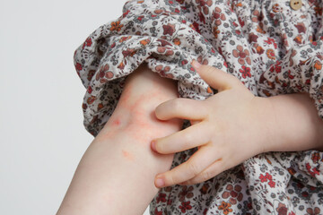 Toddler girl suffering from atopic dermatitis, close up image. Red and itchy skin. Eczema on kid's...