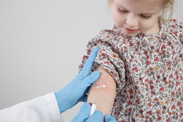Doctor applaying ointment onto red and itchy eczema on kid's arm. Toddler girl suffering from atopic dermatitis, close up image.
 - obrazy, fototapety, plakaty