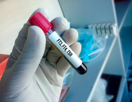 Blood sample in test tubes for hormonal examination of thyroid gland in laboratory. FT3, FT4, TSH. Diagnosis of hyperthyroidism or hypothyroidism of a patient
