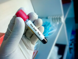 Blood sample for Uric acid test, Renal Function Test. Closeup.