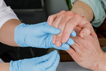 A dermatologist wearing gloves examines the skin of a sick patient. Examination and diagnosis of skin diseases-allergies, psoriasis, eczema, dermatitis