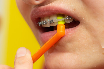 Girl with dental braces and brackets holding toothbrush for dental hygiene