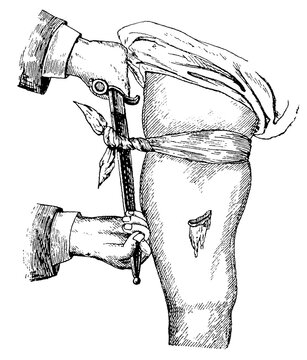 Blocking the blood flow by means of a Knebek bandage applied above the wound. Illustration of the 19th century. Germany. White background.
