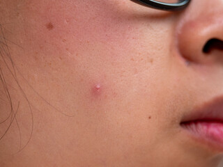 Close-up of acne on young woman's face. Concept of problem skin on female face.