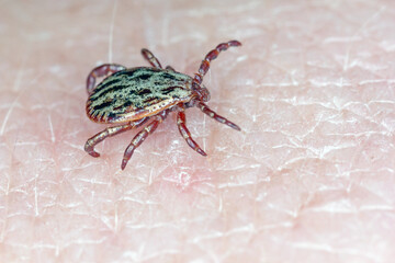 Lyme disease-carrier Ixodes tick Dermacentor marginatus on human skin.

