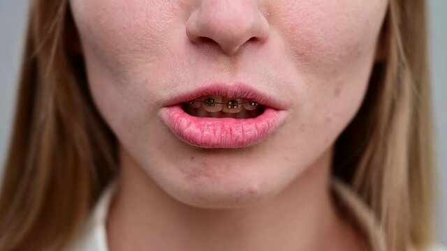 Unrecognizable red-haired girl with braces smiles. Young woman corrects bite with orthodontic appliance.