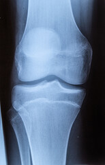 Röntgenbild, Röntgenaufnahme  von gestrecktem Knie / Kniegelenk.