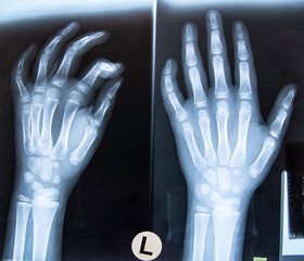 Röntgenbild, Röntgenaufnahme  von linke Hand von einem Kind.