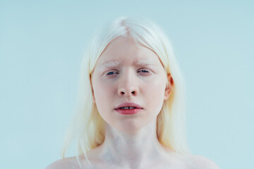 Beauty image of an albino girl posing in studio wearing lingerie. Concept about body positivity,...