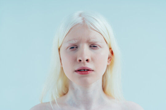 Beauty image of an albino girl posing in studio wearing lingerie. Concept about body positivity, diversity, and fashion