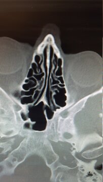 CT Scan Of The Ethmoid Sinus Air Cells