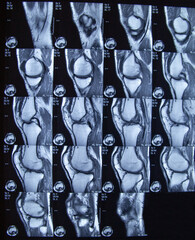 Magnetresonanztomographie / MRT von einem Knie / Kniegelenk.