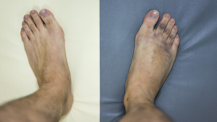 Inflammation, swelling and bruise on top of foot 