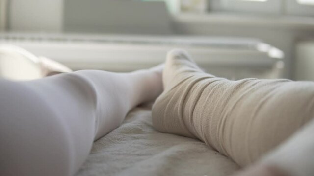 Close-up of the woman's leg in the cast of the longet when the Achilles tendon ruptured.