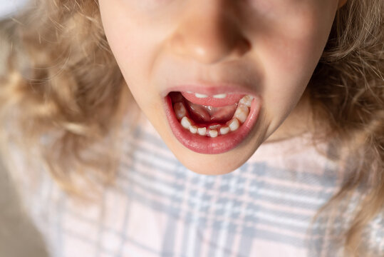 preschooler girl opens her mouth and shows new tooth that has grown behind milk tooth. Teeth grow in two rows. childrens medicine dentistry concept. selective focus