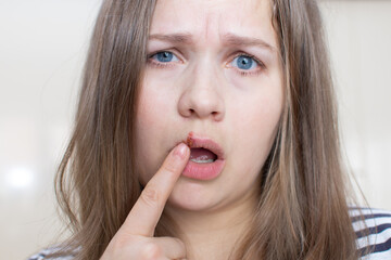 Fototapeta premium Virus herpes on the lips of a girl. Young woman with herpis virus on her lip, touching her lip with her finger.