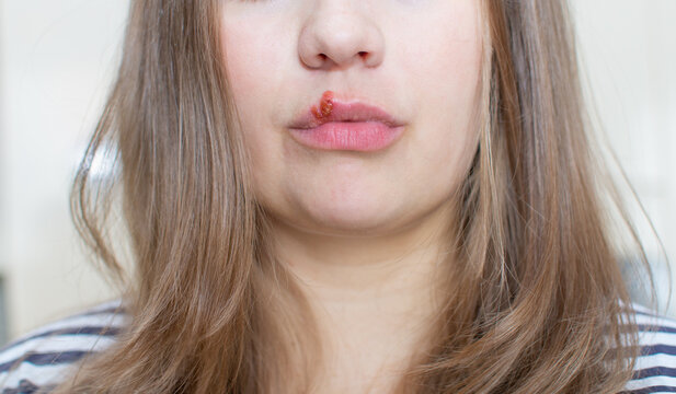 Young woman with herpis virus on her lip close up. Herpes virus on the lips of a girl.