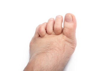 studio lighting. a human leg on a white background. The finger is strongly curved, deformed....