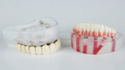 dental prostheses for temporary wearing of the upper and lower jaws on models with bars