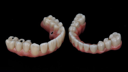 two dental prostheses made of ceramic with pink gums on black glass