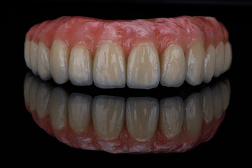 Dental prosthesis made of high-quality ceramic with pink gums of the upper jaw on black glass © Dental Pro Content