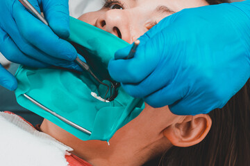 Restoration of a chewing surface by means of material for filling with photopolymer by means of the Rubber Dam system.