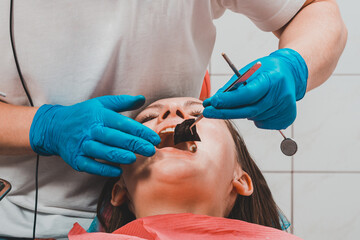 After filling, the dentist removes the excess material from the tooth with a copying tracing paper.