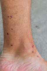 Fototapeta premium Human leg bitten by leeches