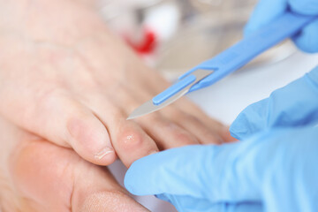 Fototapeta na wymiar Doctor removes callus with scalpel. Podiatry medical services