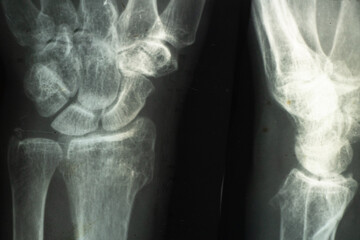 X-ray of an elderly person with osteoporosis and arthritis arthrosis, bone destruction