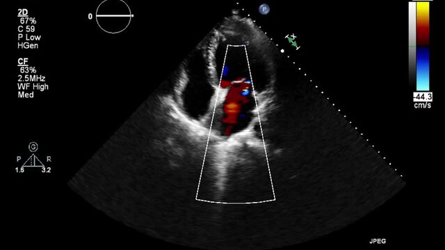 Transesophageal ultrasound video in Doppler mode.
