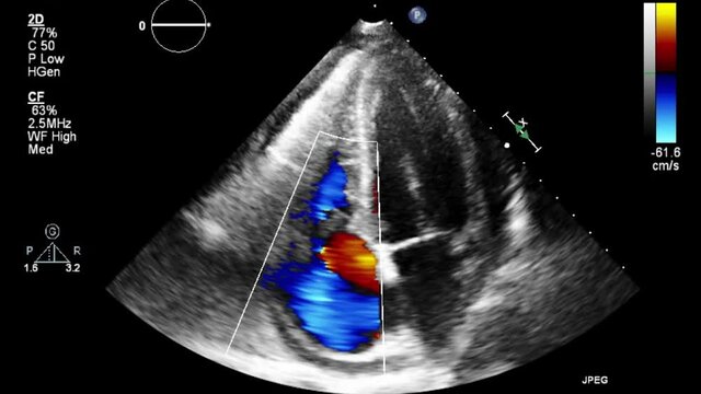 Transesophageal ultrasound video in Doppler mode.