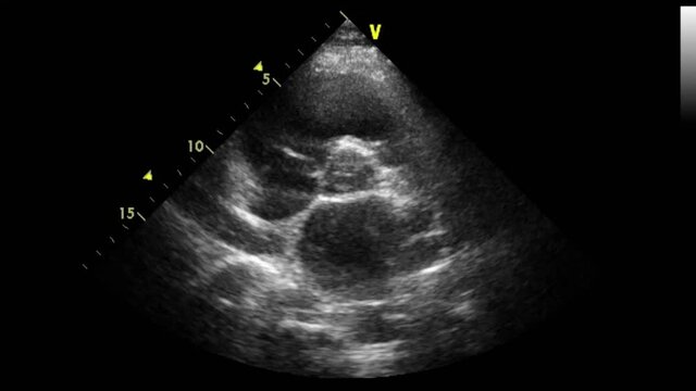 Transesophageal ultrasound video in gray-scale mode.