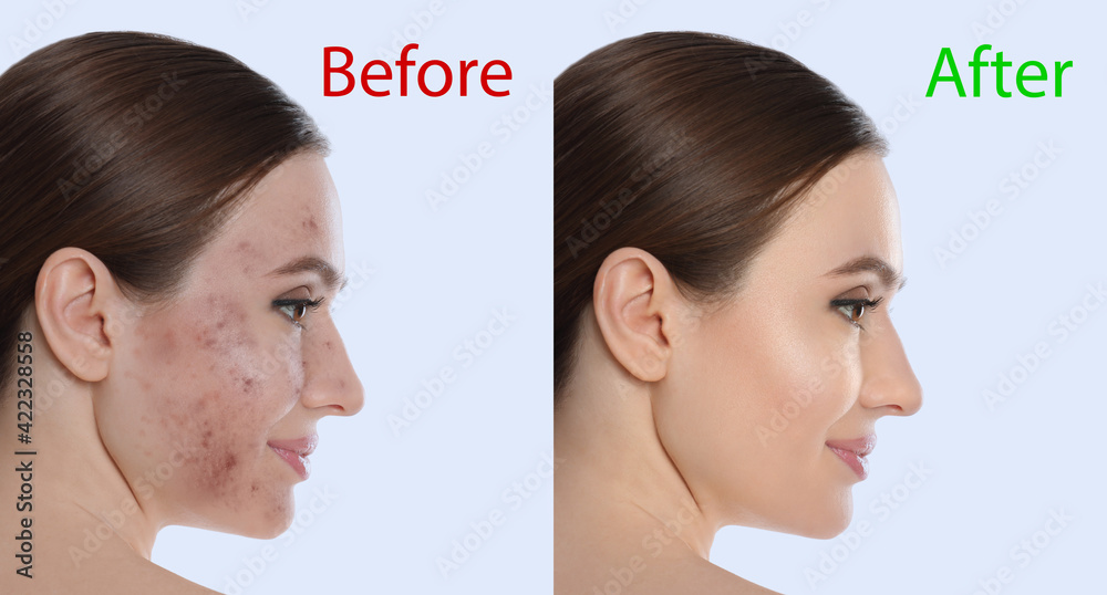 Wall mural Young woman before and after cosmetic procedure on light background